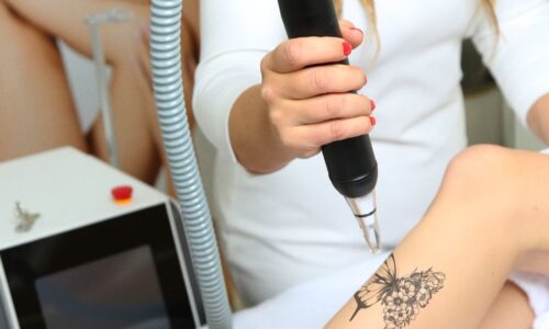 Tatto Removal